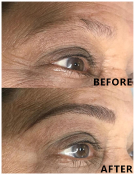 Eyes Before After