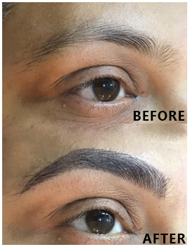 Eyes Before After