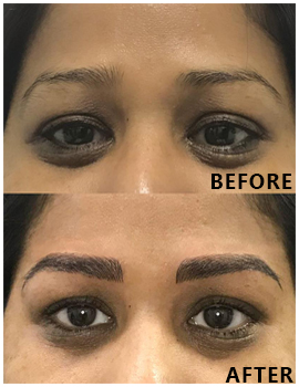 Eyes Before After