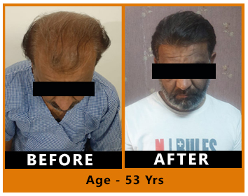 Hair Transplant Result