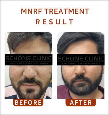 Hair Transplant Result