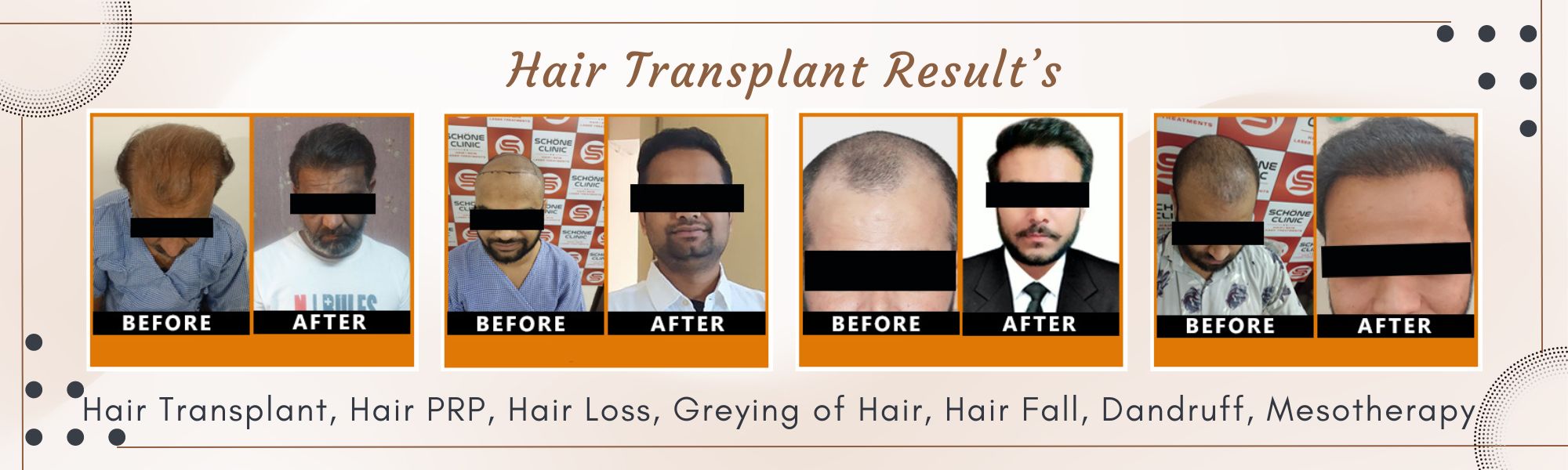 Hair Transplant Result in Six Months