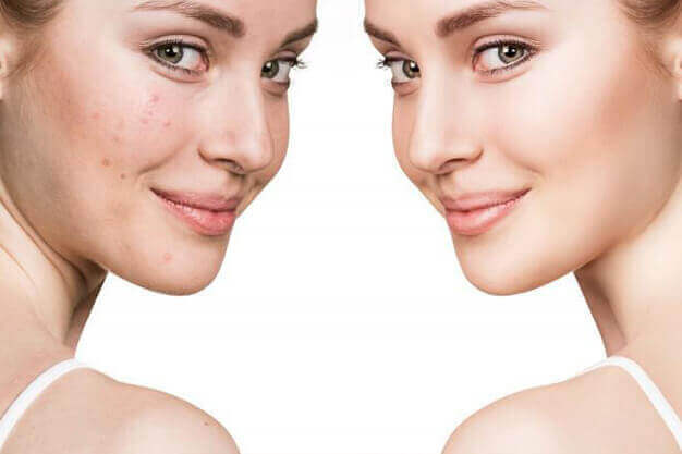 Chemical Peel