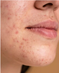 image of acne on face