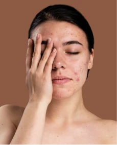 image of acne face hiding by hand