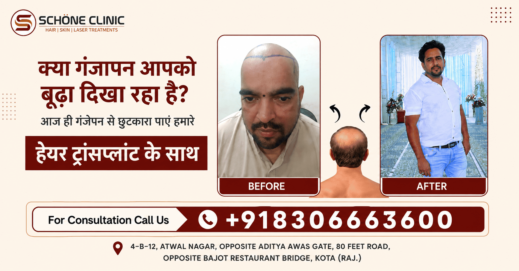 Best Hair Transplant Clinic in Kota | Hair Transplant Guide