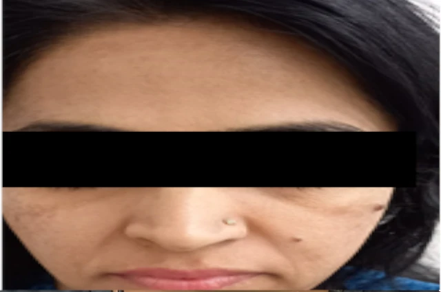 skin treatment after image