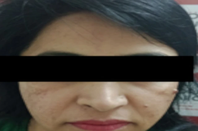 skin treatment before image
