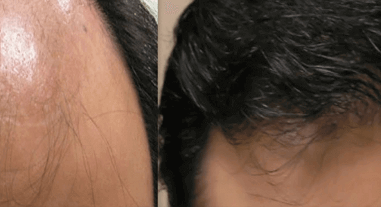 Hair Treatment